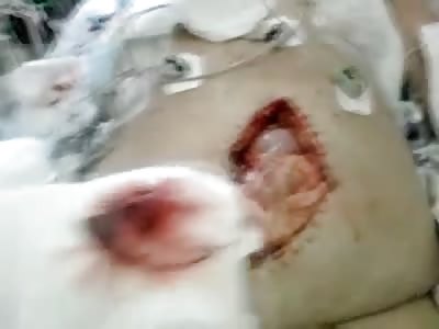 Disgusting Fat Woman's Open Wound in her Stomach