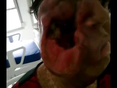 Woman Has Disgusting Hole on Her Face, What a Horrible Affliction this Poor Woman Has