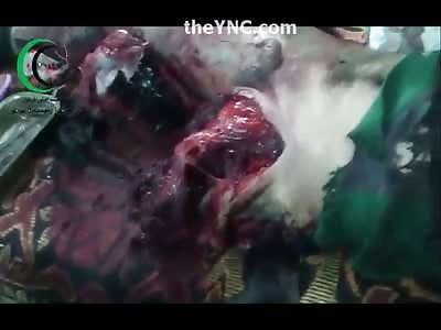 Glistening Blood after Bomb Attack Man with Ripped off Leg and Arm