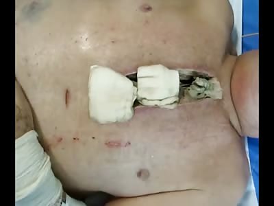 Heavy Breathing and His Chest Sliced Open