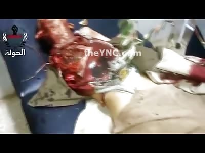 Shocking Video shows Boy with Arm Ripped off and Girl with Head Cracked Open from Syria (Video is Graphic 18+ Only!)