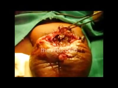 GROSS: Maggots Festering in Mans Testicles