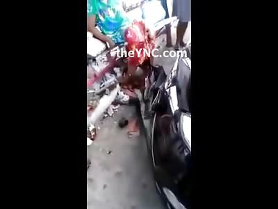 Woma nwho was Sitting at Bus Stop on a Bench lost her Legs to Out of Control Car