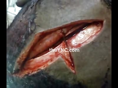 HQ Footage of Machete Slice to the Head, through the Skin, through the Skull into the Brain (Still Alive)