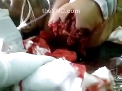 Mans With Huge Hole in his Shoulder has Seen Better Days