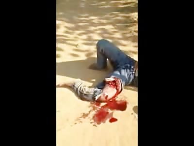 Femur Exposed in this Nasty Leg Break Accident