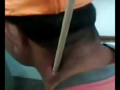 Man Sits Quietly in Hospital Room with an Iron Bar through His Neck 