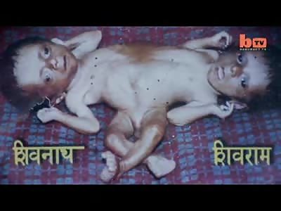 Conjoined Twins: Brothers Joined At The Hip Learn To Live In Harmony or at Least Their Version of it