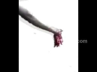 Poor Student Studying Law had his Hand Mangled by Police During Protest