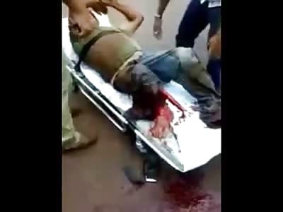 Mans Leg Snapped in Half Bone Exposed....Agony!