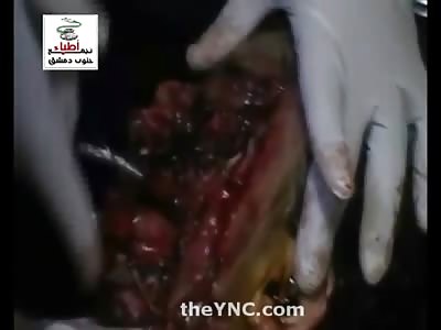 Hard to Watch Video of Boy with His Face Blown Off and a Man with Gruesome Facial Injury