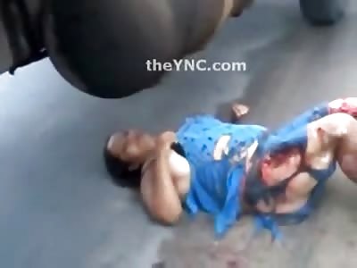 Heavy Set Woman with Big Legs has the Fat hanging Off of Them after Accident