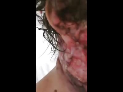 Woman with Disgusting Wound in the Face, Cameraman will not Show her Face