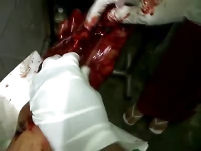 Horrible Foot Injury Skinned Down to the Bone and Missing Toes