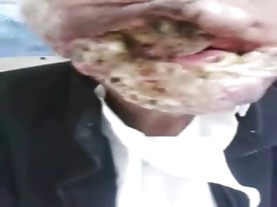 Flesh Eating Disease has this Face Like WTF!!!