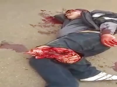 Dude in Total Shock with his Leg Basically Ripped the Fuck Off