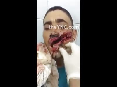 Gonna Need Dentures from Now On Buddy...Man Skimmed by a High Powered Rifle Round is in Trouble (Short Video) 