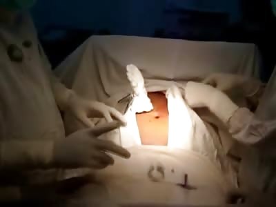 Man Stabbed with the Knife Still in his Gut Gets it Removed 