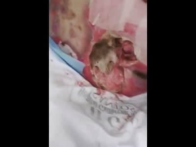 Doctor puts his Fingers into a Disgusting Ulcer on a Mans Ass