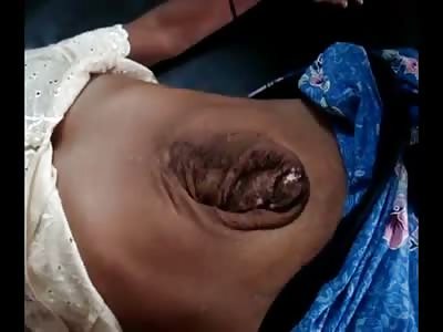 Disgusting Hernia Moves with Every Breath 