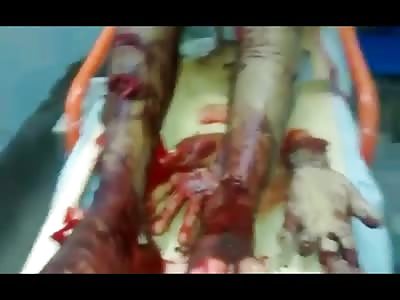 True Life Horror Movie shows Man with Both Hands Chopped Off by a Machete Squirming on Hospital Bed