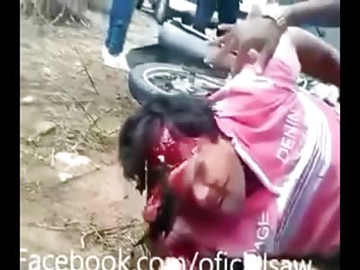 Mans Face is Peeling Off after Accident