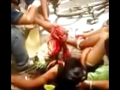 EMT's Twist a Kids Mangled Leg Completely Around to Help Him (Watch at :40 Second Mark) 