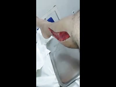 Leg Sliced Open and the Muscles Still Moving