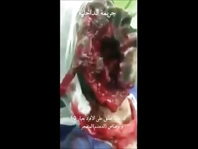 Saudi Man Shot in the Face with a .50 Cal Somehow is STILL Alive