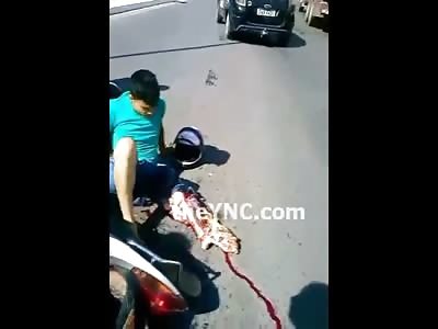 Amazing Video of Boy Motorcyclist with Leg Shredded All the Way to the Bone Revealing his Skeleton 