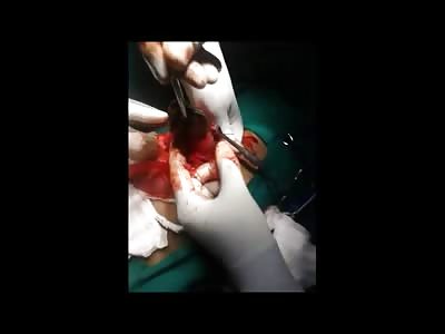 Another Very Bizarre Case of Hair Being Removed from Stomach