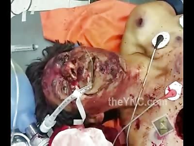 Dude with MASSIVE Hole in his Chest on Operating Table