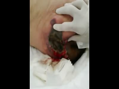 Horrific and Disgusting Hole on Mans Butt