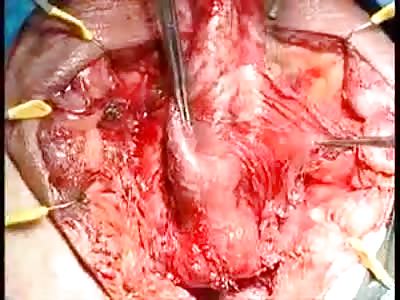 man to woman swap sex change surgery