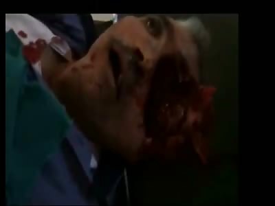 Very Short Vid of man with a Good Part of His Face Missing