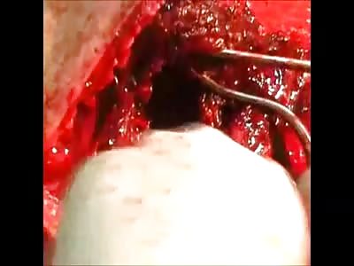 Man With Open Wound in the Leg and Artery Spurting... Doctors Wondering How to Fix it