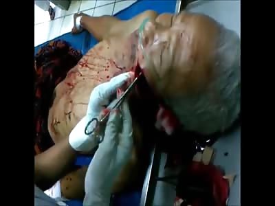 Machete blow on the face being sutured in emergency room