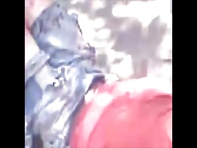 Man with mangled leg after accident... hanging flesh.