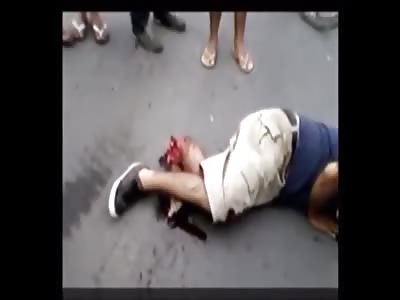 Man in Agony with His Mutilated Leg after Being Hit by Car