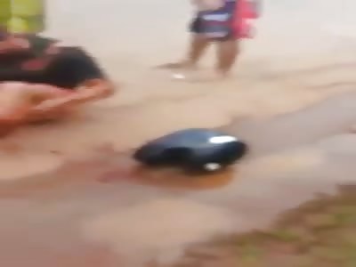 Man with lower leg broken and bone exposed after motorcycle accident