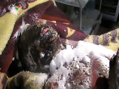 Kid burned by Kerosene still alive! Graphic warning