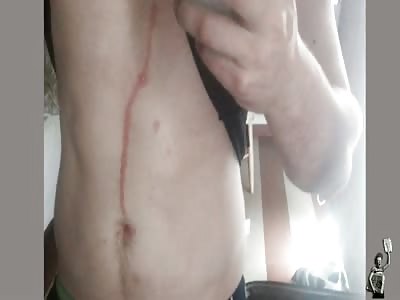  Doctors find spider in man's abdomen after burrowing into his skin