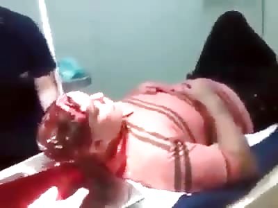 Head Split Hit with a Horse Hoof