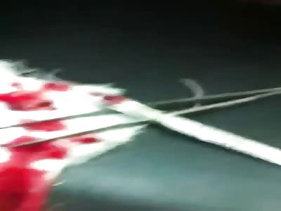 Work Accident results in Man Losing his Finger 