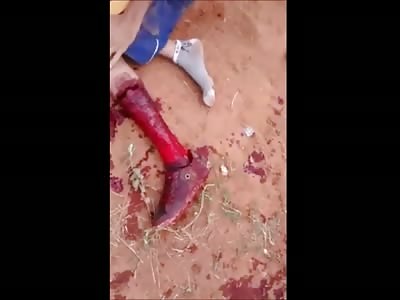 Boy Victim of a Robbery was hit in the Leg with a Machete