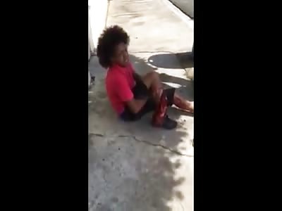 Man with Lower Leg Ripped Shredded Off after Car Accident 