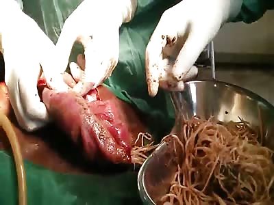 Intestinal worm extraction, or too many noodles for lunch?