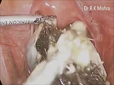 Hairy pus extraction.