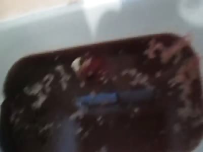 Fun with Vericose Veins