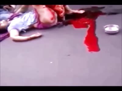 Woman with Mangled Leg 